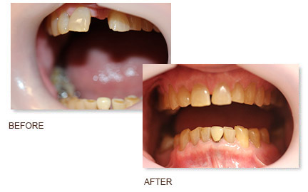 Real Invisalign Patient